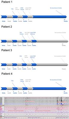 Obstructive Sleep Apnea (OSA) and Patent Foramen Ovale (PFO), the “Perfect Storm” for a Cryptogenic Stroke? Case Series of Four Patients